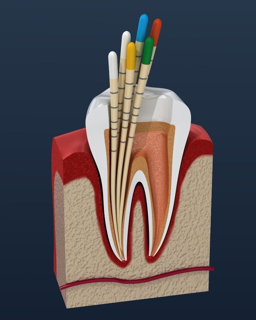 endodonzia olbia