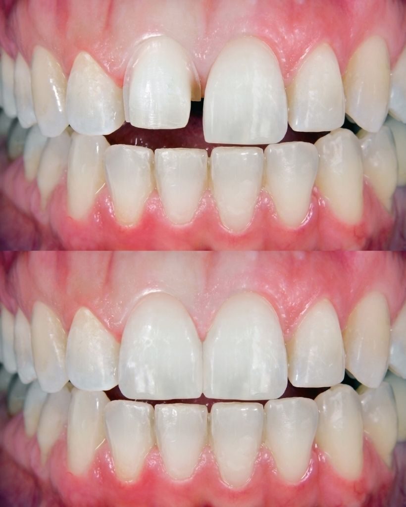 faccette dentali olbia